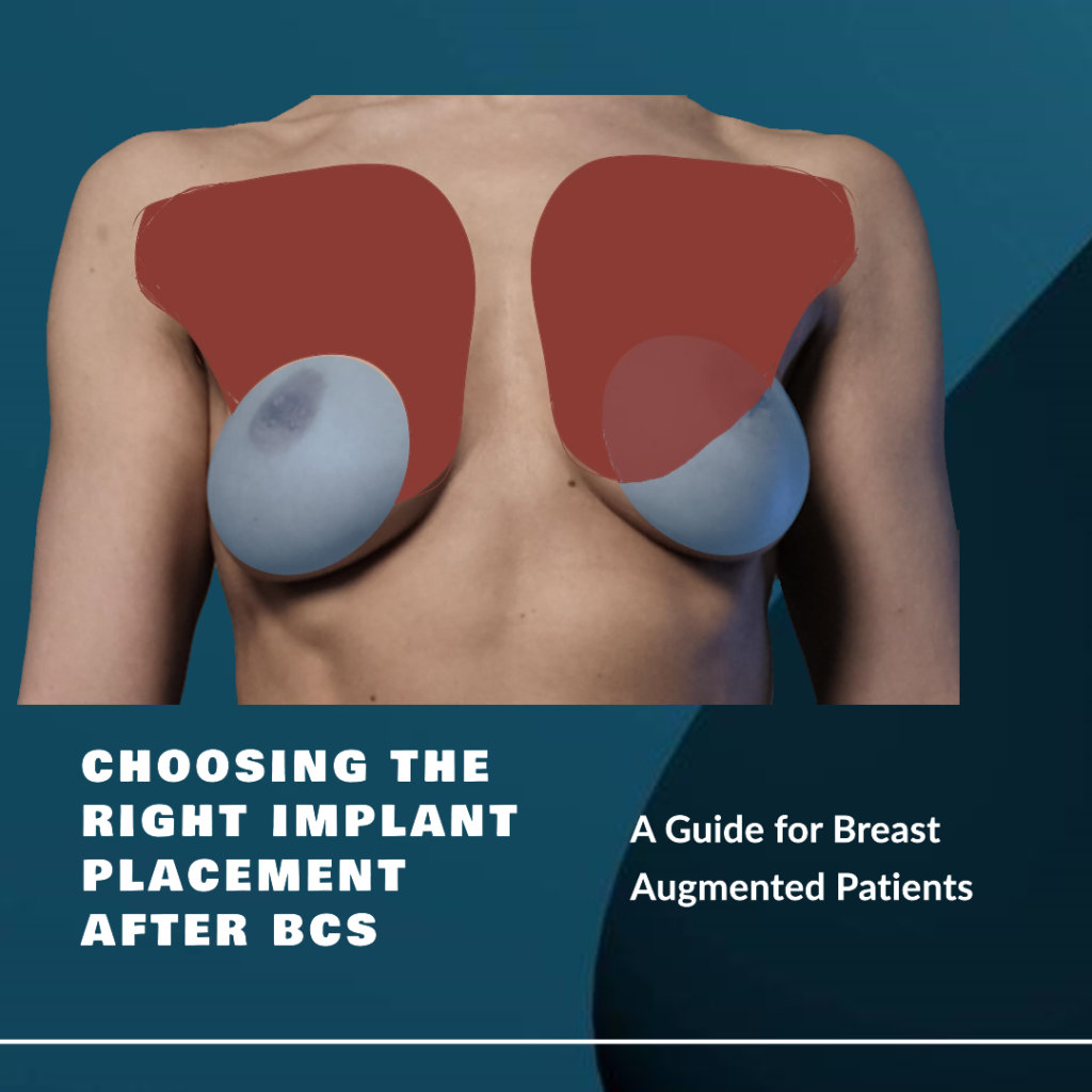 Implant placement afte BCS in breast augmented patients
