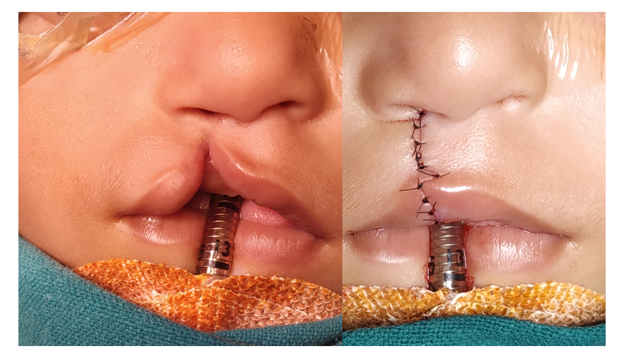Cleft lip palate