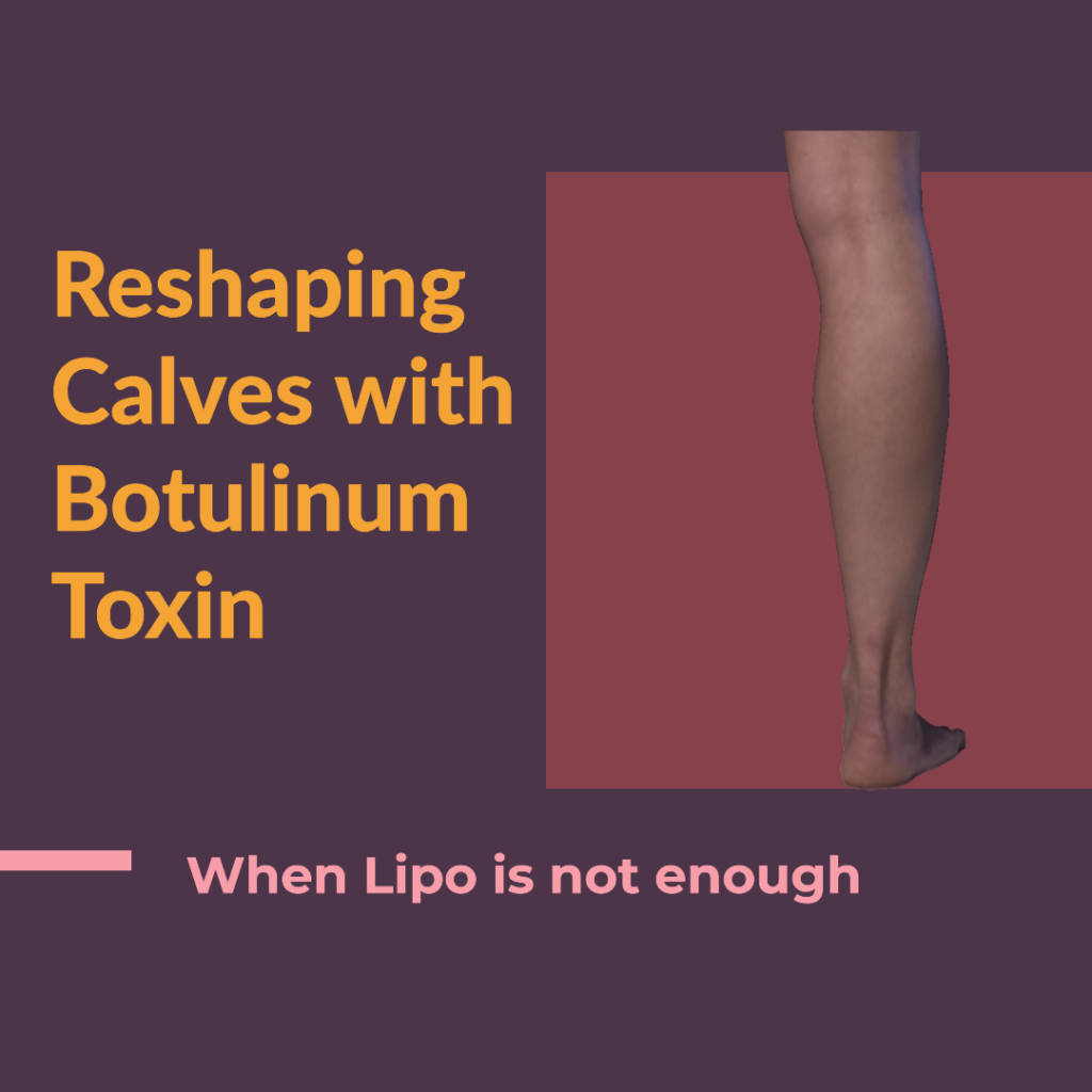 Using botulinum toxin in calf contouring