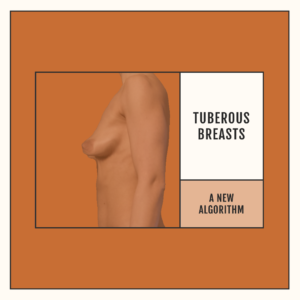 tuberous breasts