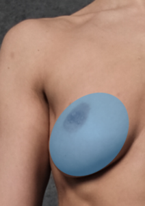 Breast implant